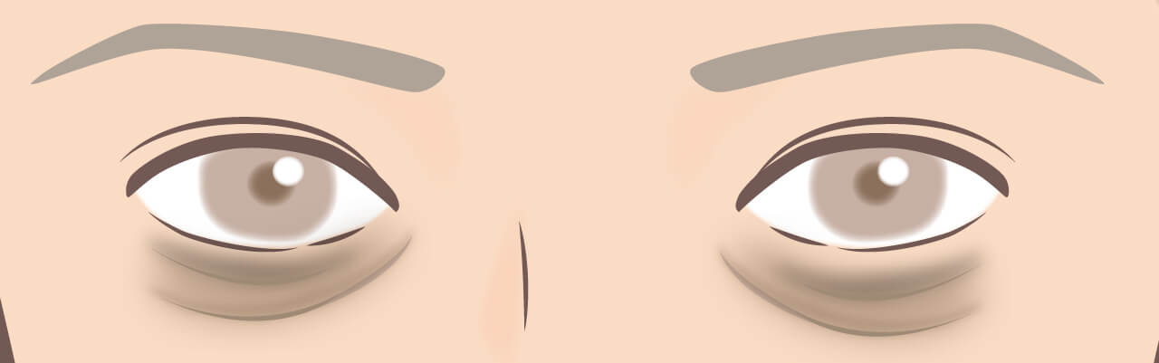 下眼瞼脱脂術が効果的なのは黒クマ