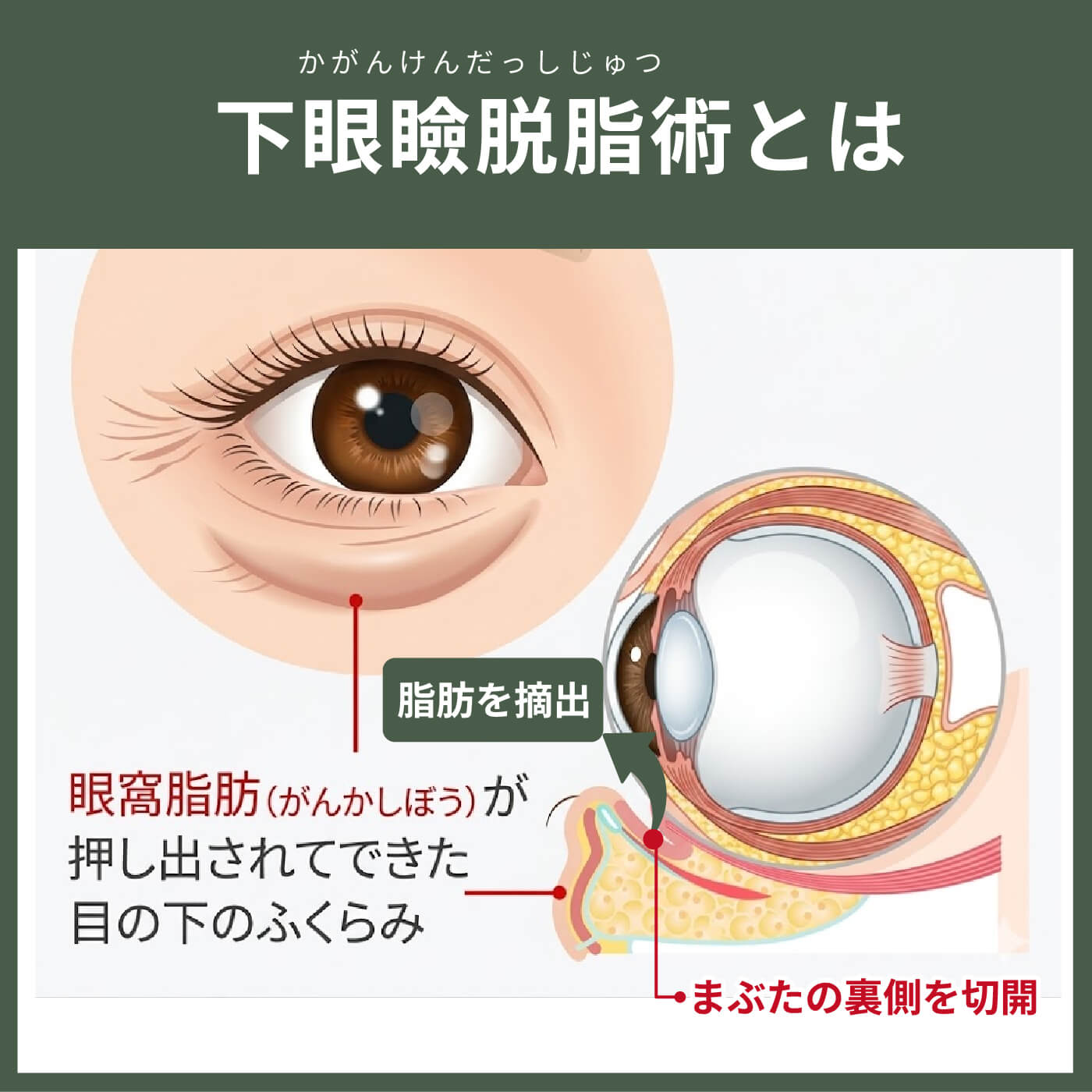 下眼瞼脱脂術とは