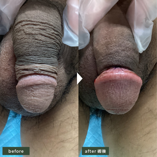 30代 包茎治療+亀頭増大