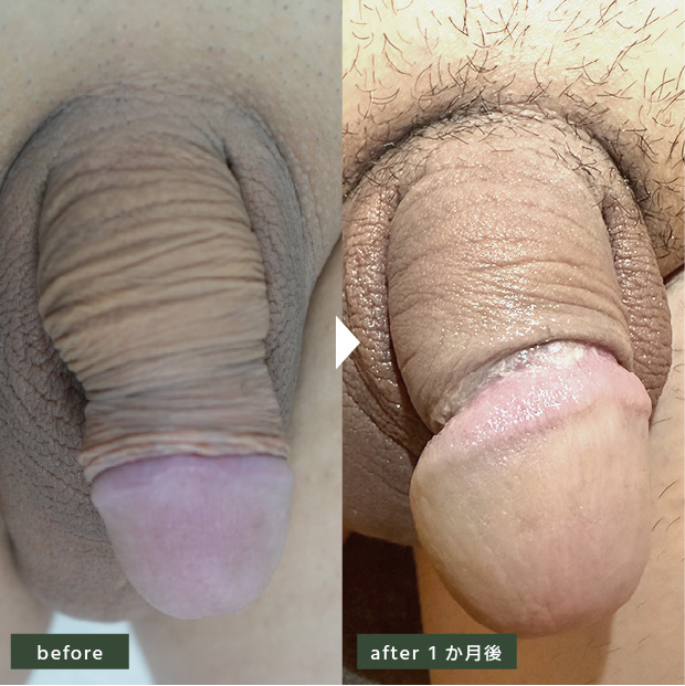 30代 包茎治療+亀頭増大