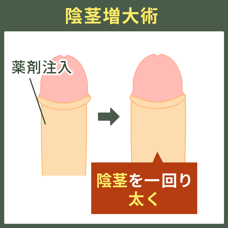 陰茎増大術の図解