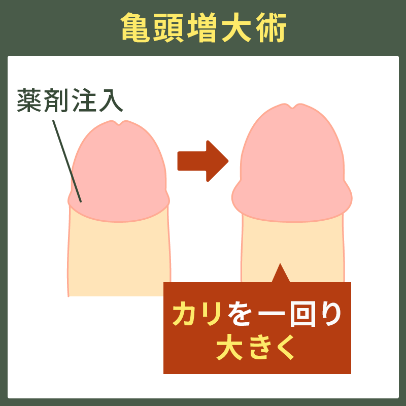 亀頭増大術の図解