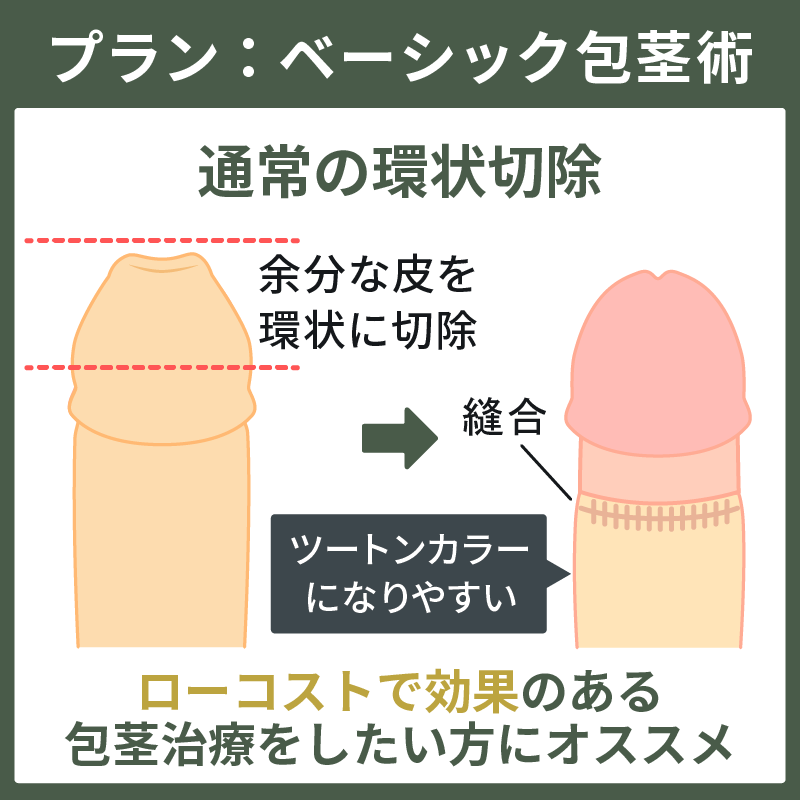 余分な包皮を環状に切除するベーシック包茎術の解説