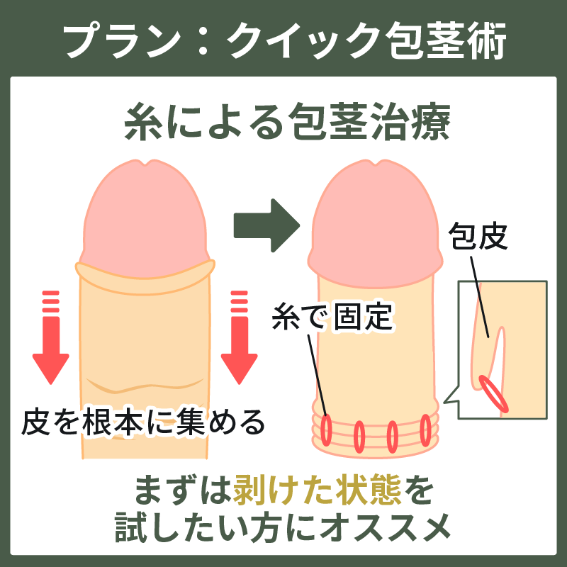 クイック包茎術