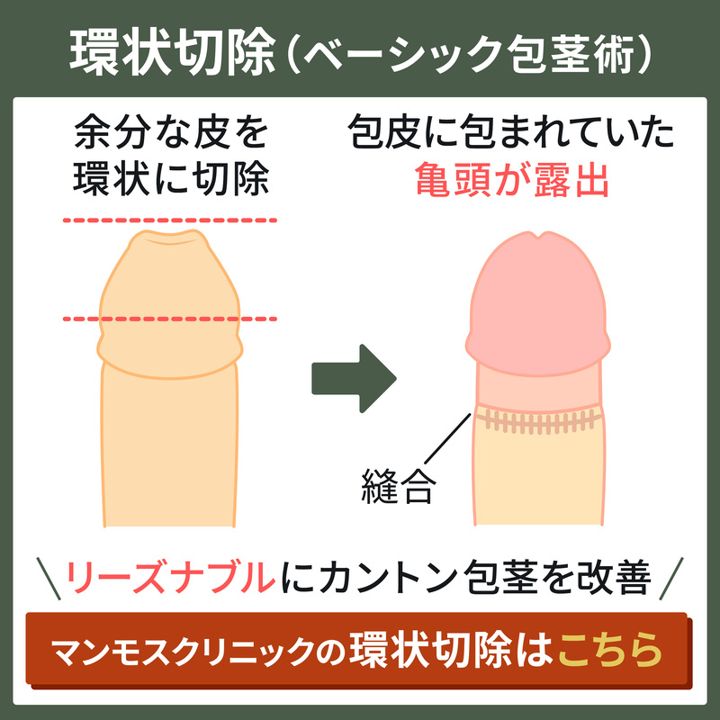 環状切除による包茎手術の仕組み