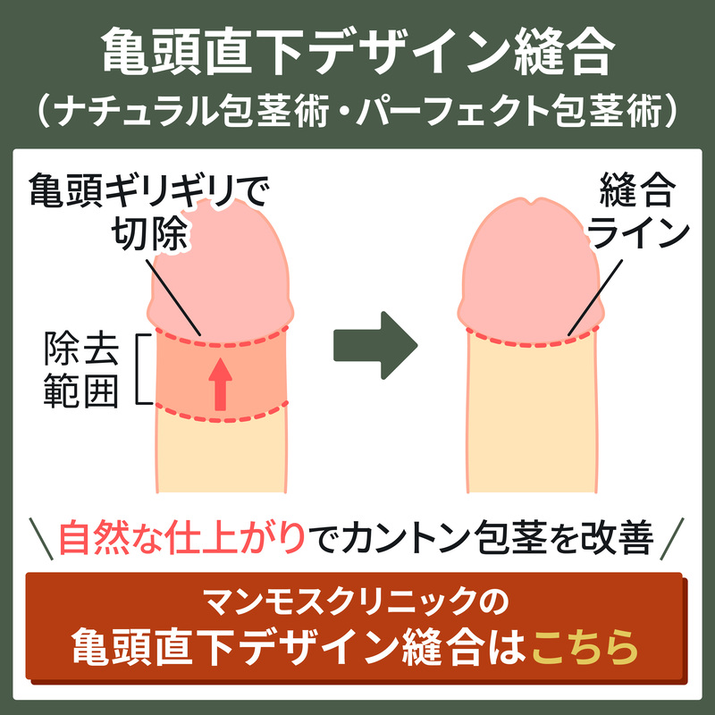 亀頭直下デザイン縫合による包茎手術の仕組み