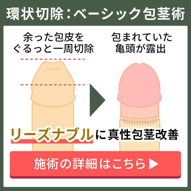 余分な包皮を環状に切除するベーシック包茎術の解説