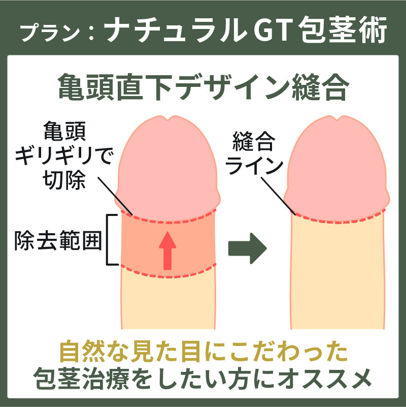 通常時自然な見た目になるナチュラルGT包茎術