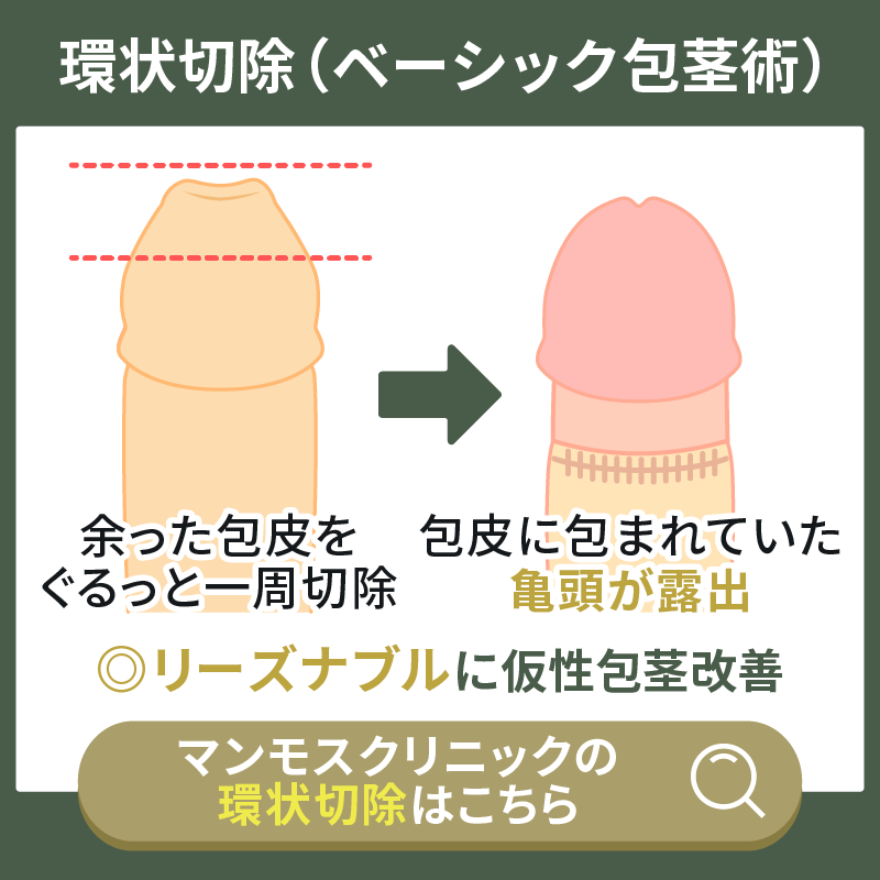 余分な包皮を環状に切除するベーシック包茎術の解説