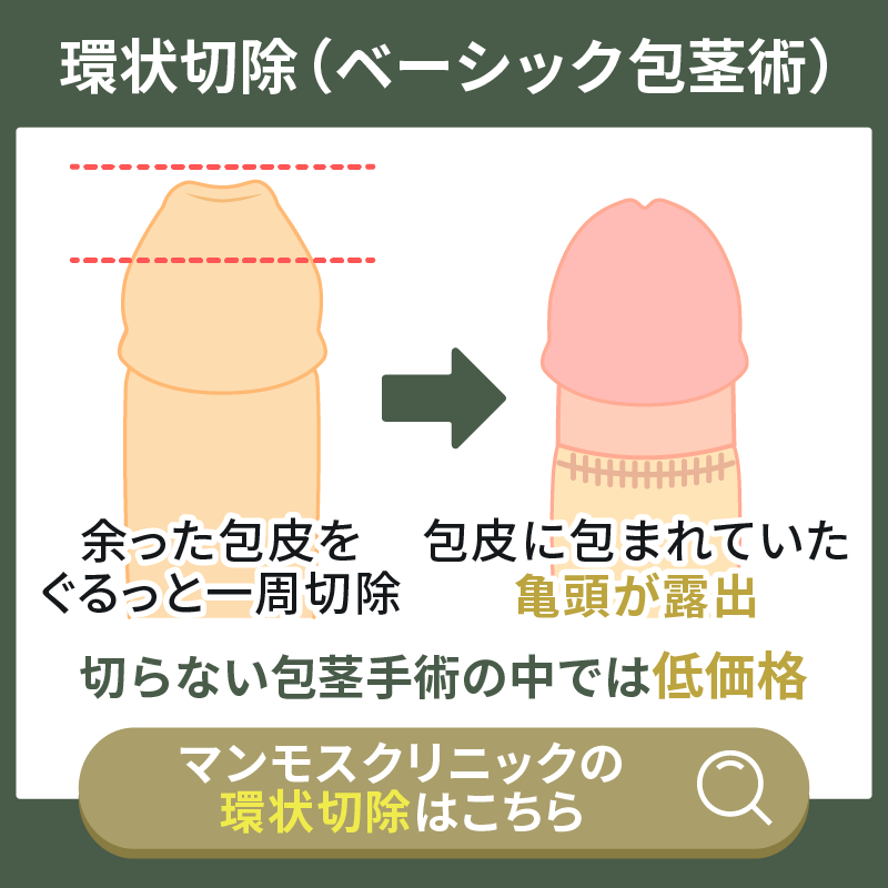 余分な包皮を環状に切除するベーシック包茎術の解説