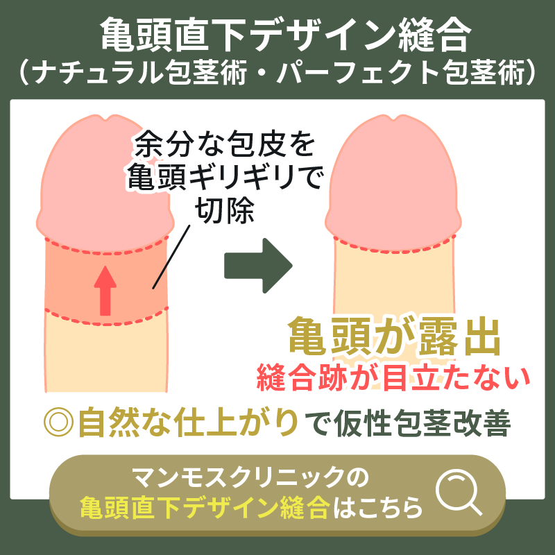 亀頭直下デザイン縫合による包茎手術の仕組み