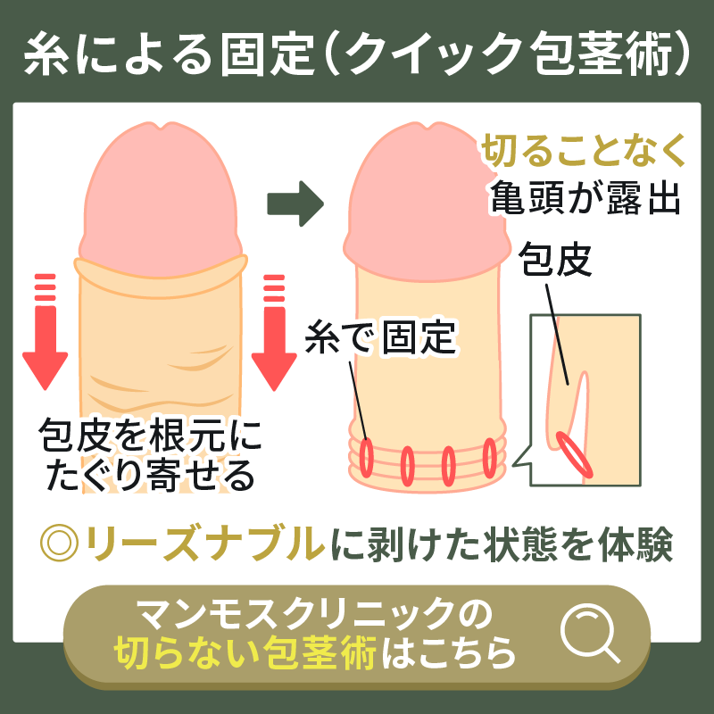 糸での包皮の固定による包茎手術の仕組み