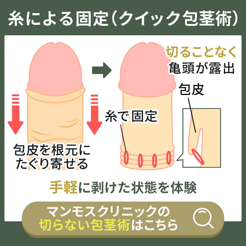 包皮を糸で固定するクイック包茎術の解説