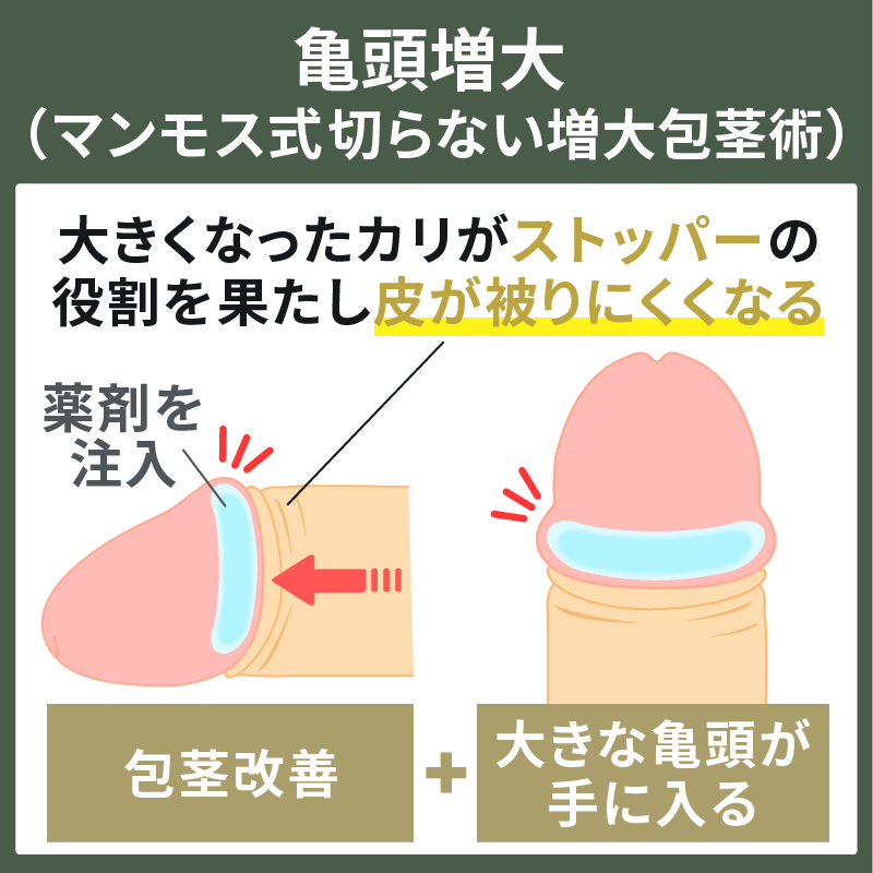 亀頭増大による包茎手術の仕組み